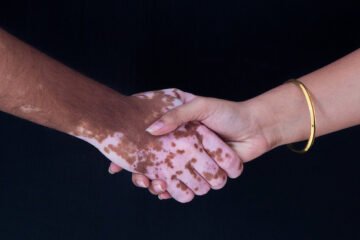 Vitiligo természetgyógyászati megközelítése