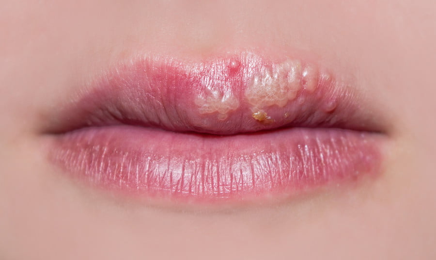 Hpv felső ajak, HPV fertőzés a szájban - Orvos válaszol